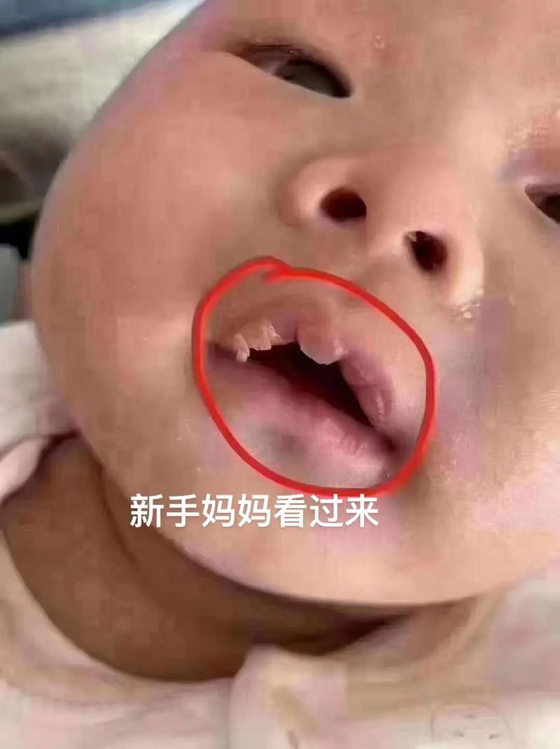 新生儿嘴上起奶泡是正常现象吗？需要处理吗？-第1张图片-郑州医学网