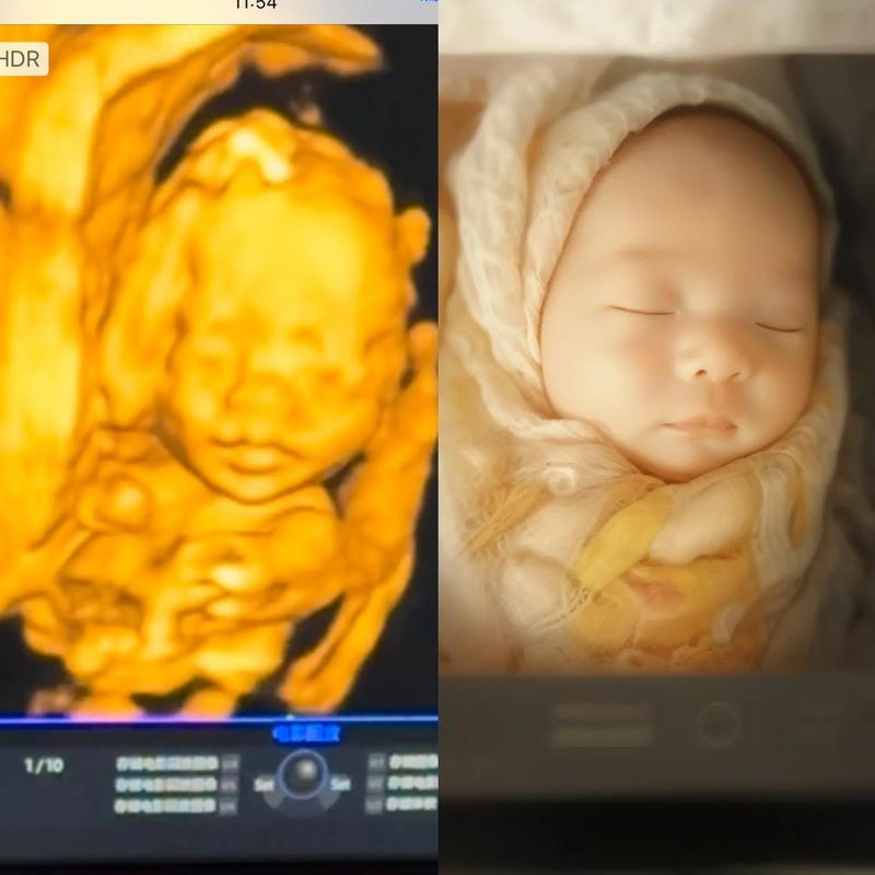 孕期四维彩超到底该做几次？两次检查有必要吗？-第2张图片-郑州医学网