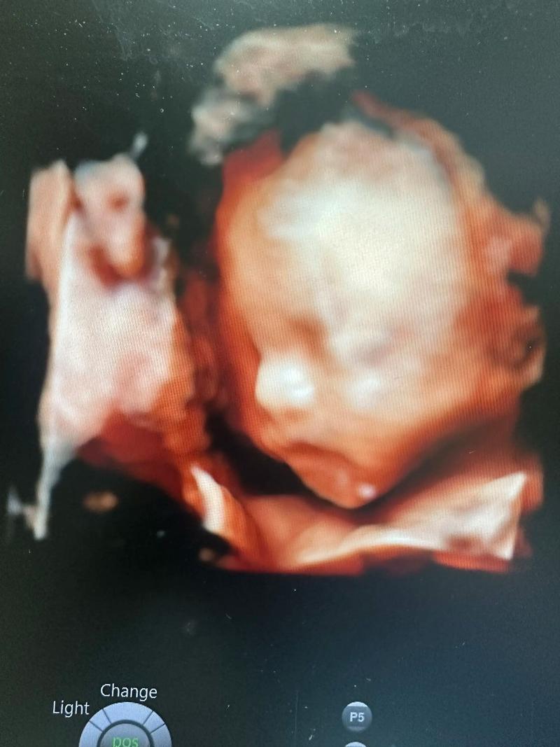 孕期四维彩超到底该做几次？两次检查有必要吗？-第3张图片-郑州医学网