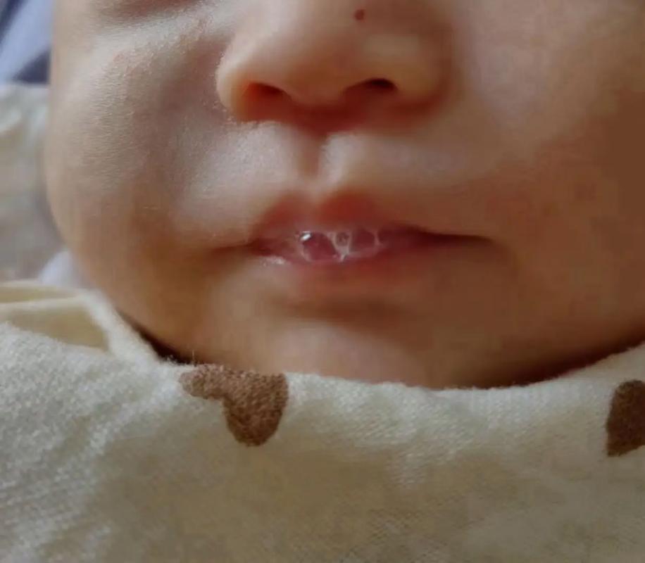 新生儿嘴巴上的白泡是正常现象还是疾病信号？需要处理吗？-第1张图片-郑州医学网