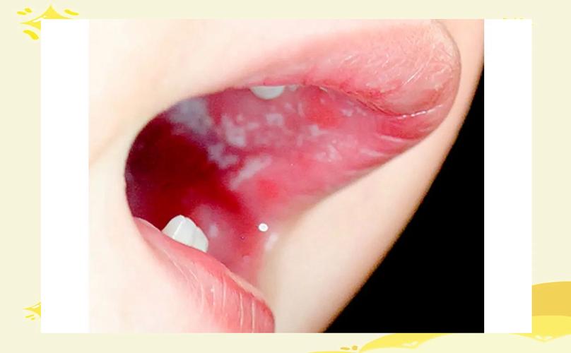 新生儿嘴巴上的白泡是正常现象还是疾病信号？需要处理吗？-第3张图片-郑州医学网