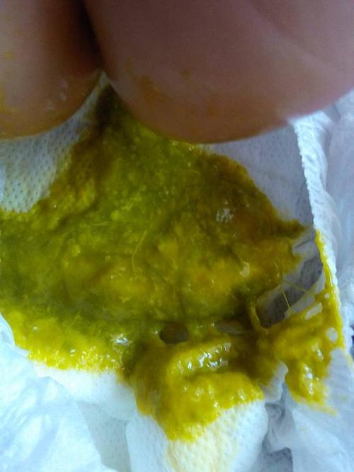 新生儿便便发绿带粘液是消化不良还是感染信号？-第2张图片-郑州医学网