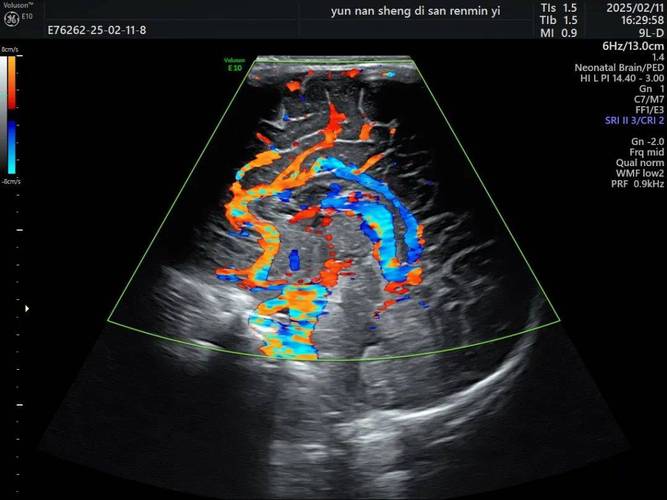 新生儿头颅彩超到底是什么检查，它对宝宝健康有何重要意义呢？-第2张图片-郑州医学网