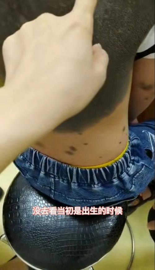 新生儿后背黑毛是正常现象吗？需要担心健康问题吗？-第2张图片-郑州医学网