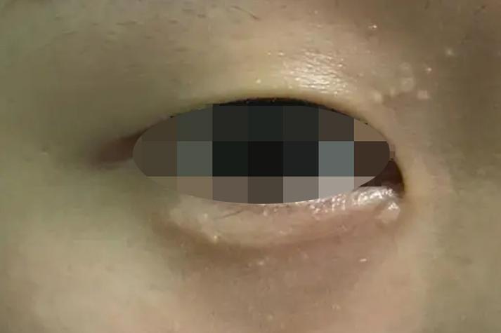 新生儿眼角长了脂肪粒怎么办？需要处理吗？会影响视力吗？-第1张图片-郑州医学网