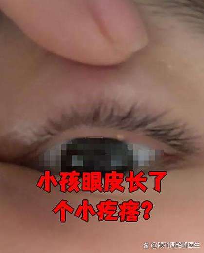 新生儿眼角长了脂肪粒怎么办？需要处理吗？会影响视力吗？-第2张图片-郑州医学网