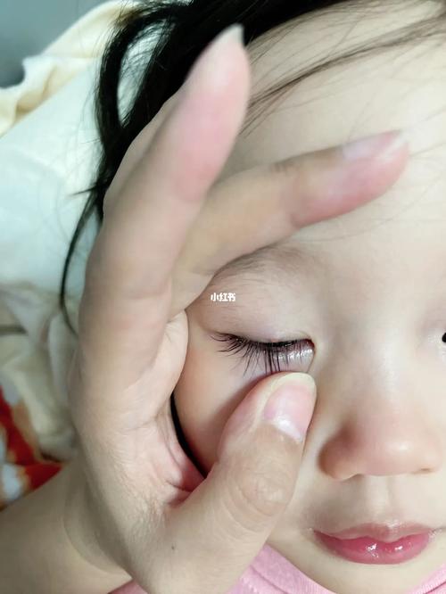 新生儿眼角长了脂肪粒怎么办？需要处理吗？会影响视力吗？-第3张图片-郑州医学网