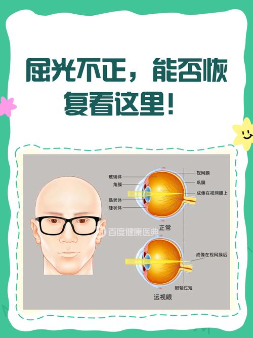 儿童屈光度是什么？它与视力发育、近视防控有何关联？-第3张图片-郑州医学网