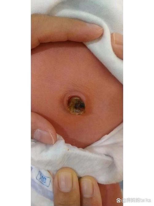新生儿肚脐眼有臭味是感染了吗？该怎么处理和预防？-第1张图片-郑州医学网
