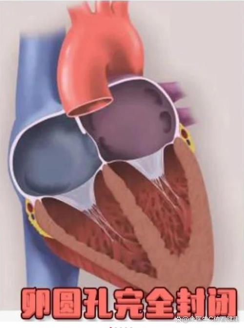 新生儿卵圆孔未闭是普遍现象吗？需要治疗吗？-第2张图片-郑州医学网