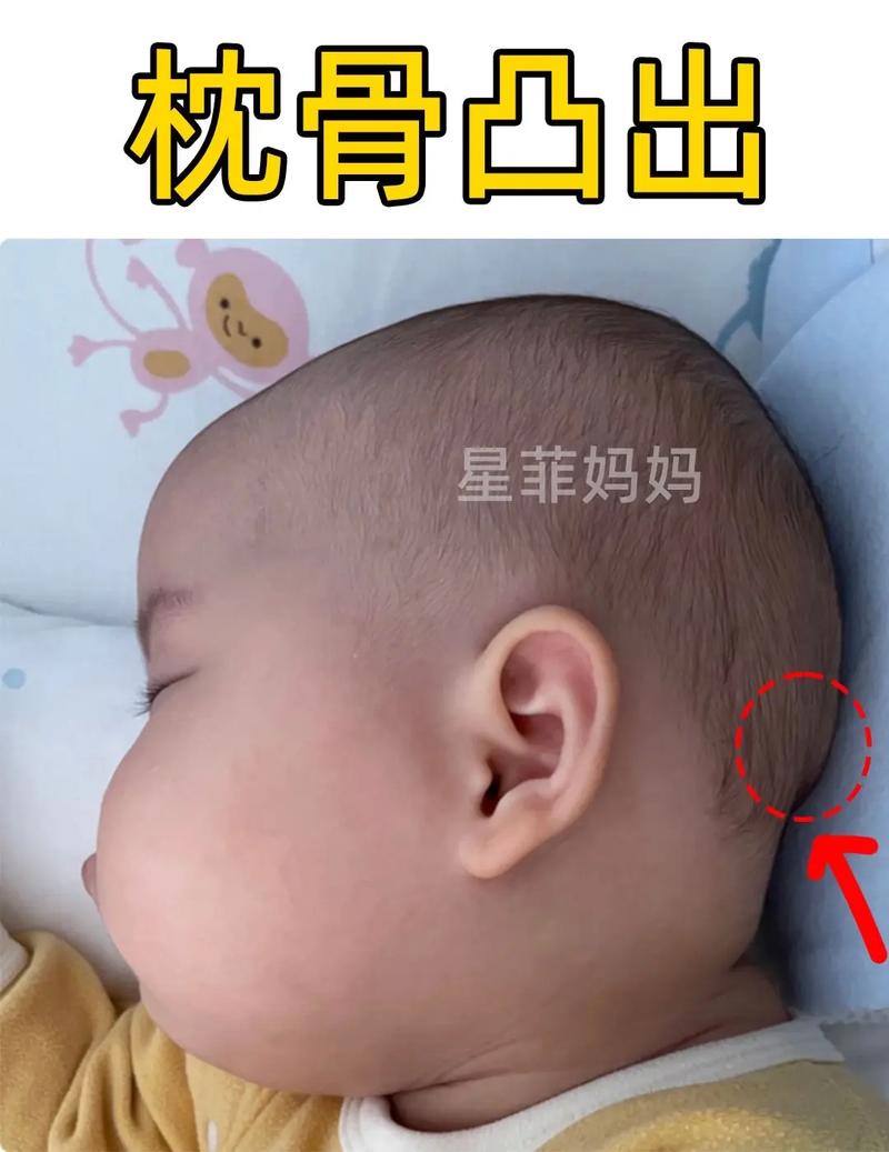 新生儿前头骨凹凸不平是正常生理现象还是异常信号？需警惕哪些潜在问题？-第1张图片-郑州医学网