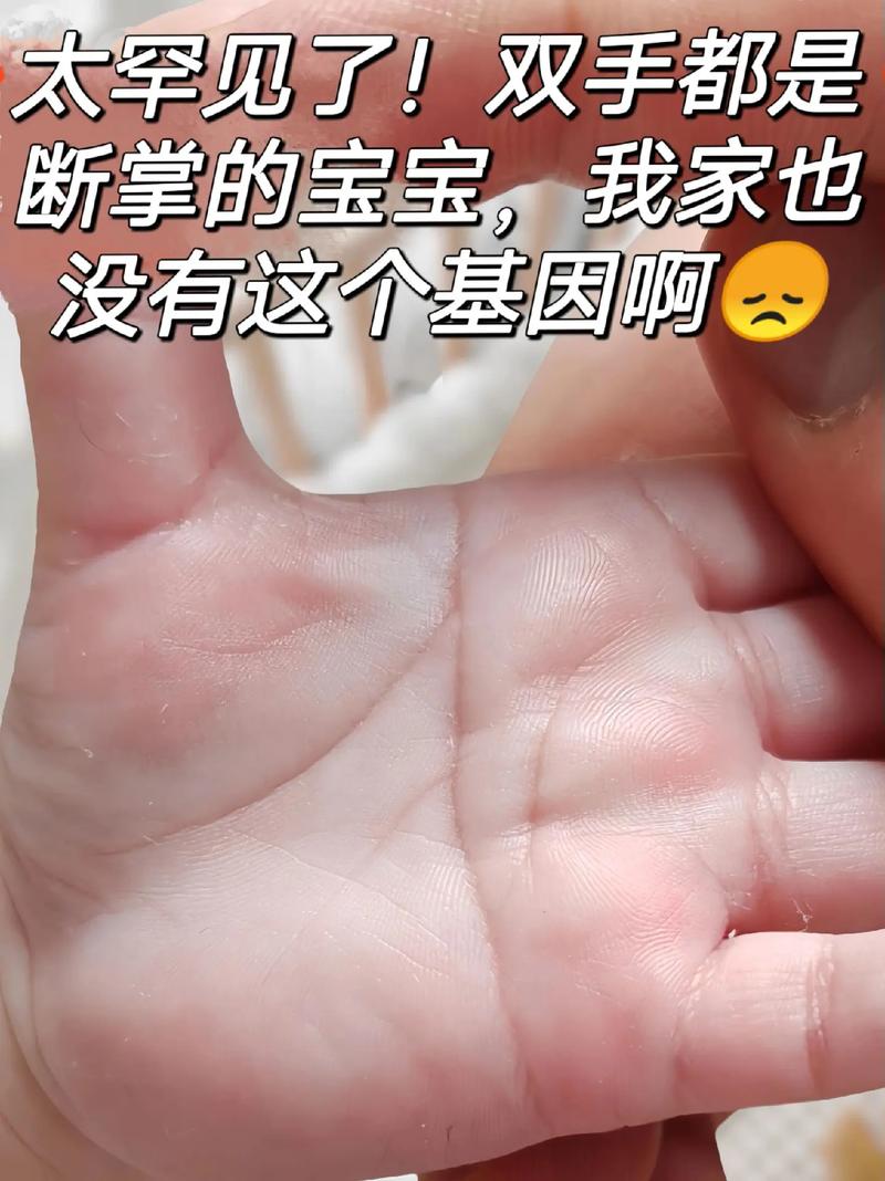 新生儿手纹断掌好不好-第1张图片-郑州医学网