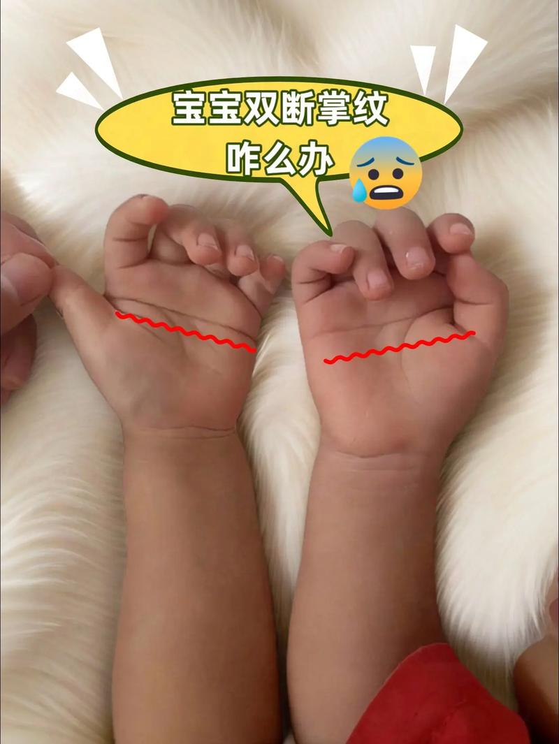 新生儿手纹断掌好不好-第3张图片-郑州医学网