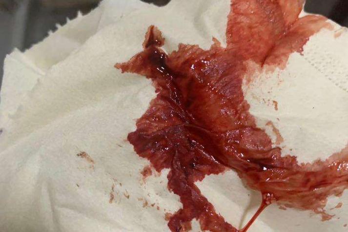 怀孕期间流暗红色的血-第2张图片-郑州医学网