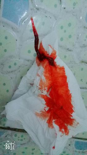 怀孕期间流暗红色的血-第3张图片-郑州医学网