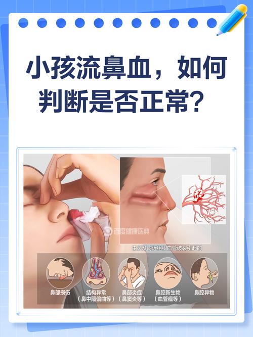 儿童鼻子出血该挂耳鼻喉科还是儿科？不同情况如何选择？-第3张图片-郑州医学网
