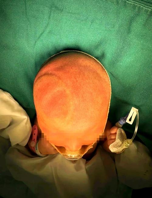 新生儿头部凹凸不平是正常现象还是异常信号？需要警惕哪些问题？-第1张图片-郑州医学网