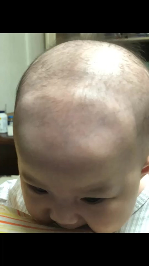 新生儿头部凹凸不平是正常现象还是异常信号？需要警惕哪些问题？-第2张图片-郑州医学网