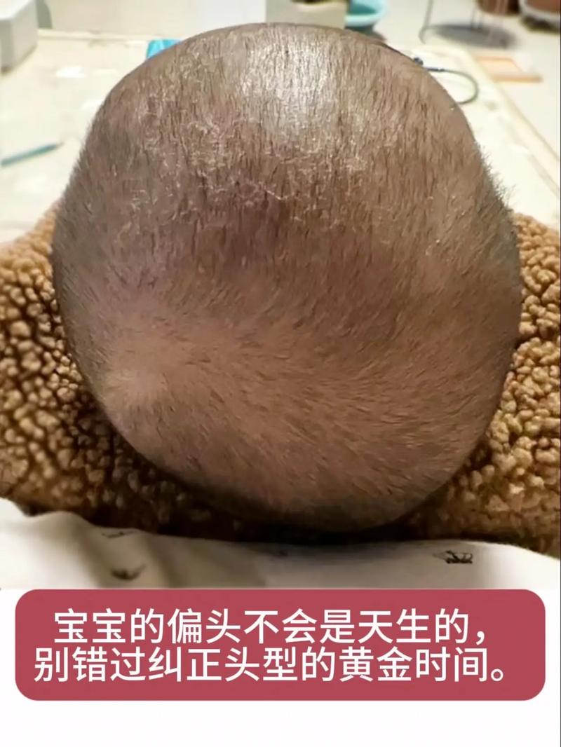 新生儿头部凹凸不平是正常现象还是异常信号？需要警惕哪些问题？-第3张图片-郑州医学网