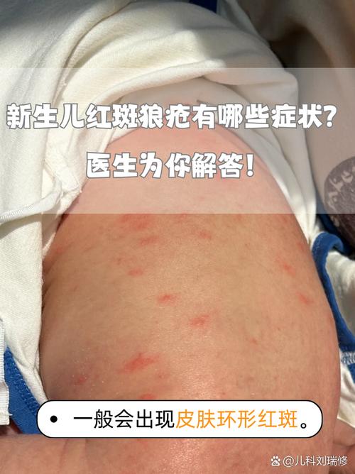 新生儿红斑图片显示症状，该如何科学治疗与护理？-第1张图片-郑州医学网