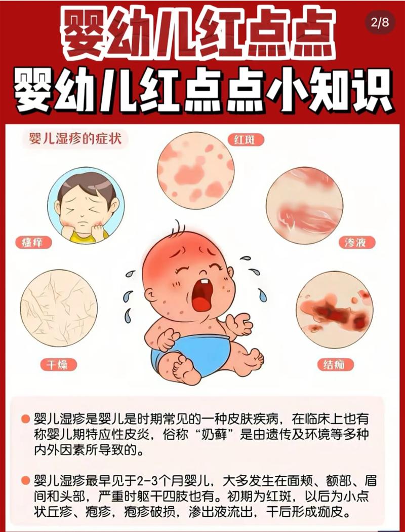 新生儿红斑图片显示症状，该如何科学治疗与护理？-第2张图片-郑州医学网