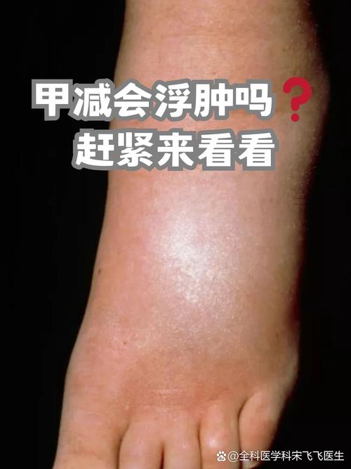 怀孕期间甲减会怎么样-第3张图片-郑州医学网