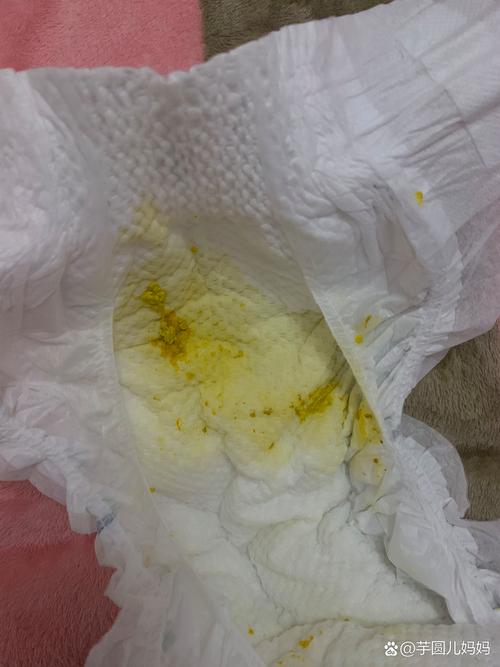 新生儿黄疸期间拉黄屎是正常现象还是需要警惕的信号？-第1张图片-郑州医学网