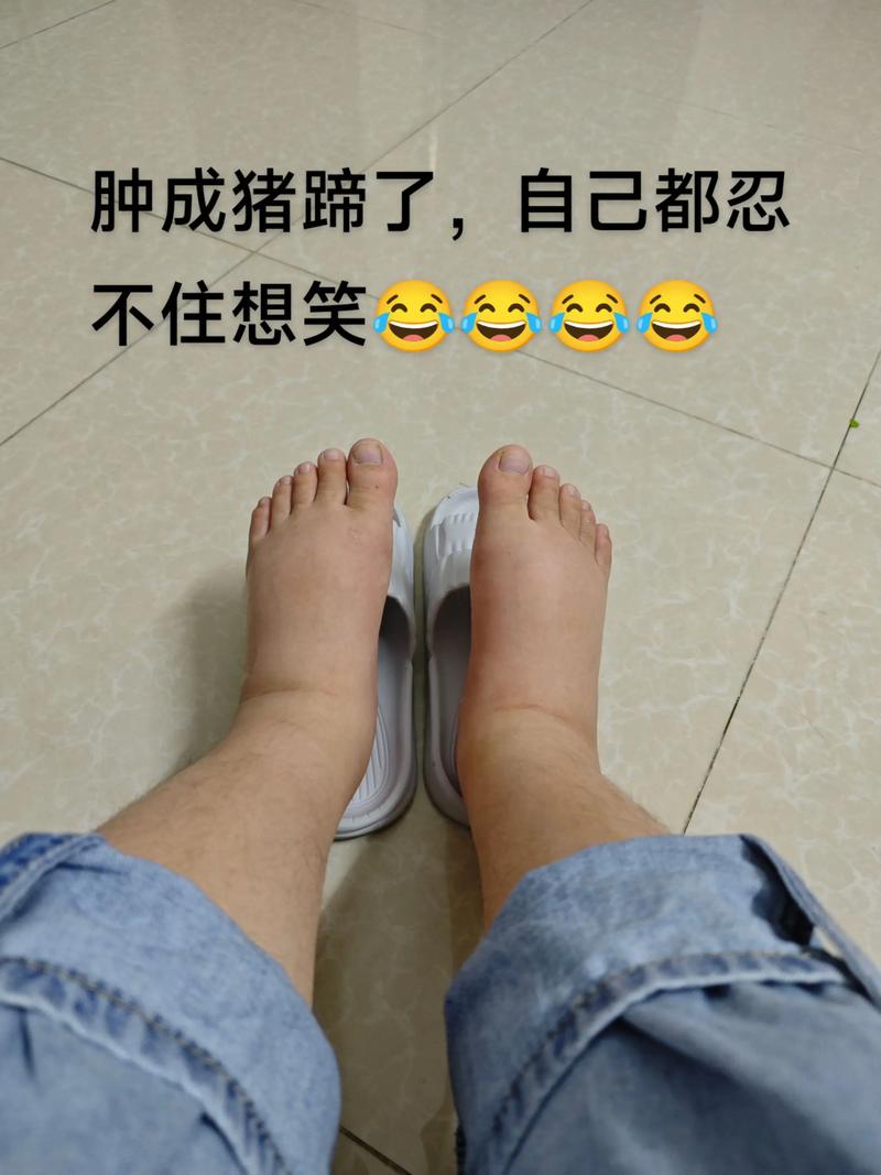 怀孕期脚肿是正常现象还是身体发出的健康预警信号？-第2张图片-郑州医学网