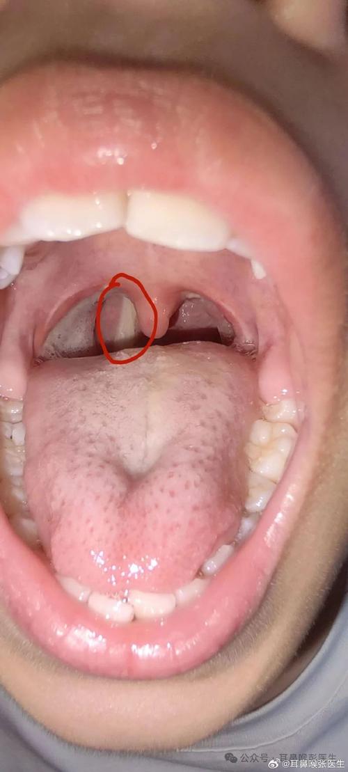 新生儿嗓子有痰正常吗？是生理现象还是疾病信号？需不需要干预处理？-第1张图片-郑州医学网