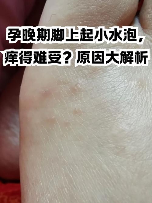 怀孕期间脚丫痒得难受，到底是什么原因引起的？-第1张图片-郑州医学网