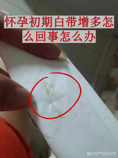怀孕期间下面出现豆腐渣状分泌物是感染了吗？对胎儿有影响吗？-第1张图片-郑州医学网