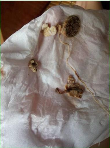 怀孕期间下面出现豆腐渣状分泌物是感染了吗？对胎儿有影响吗？-第2张图片-郑州医学网