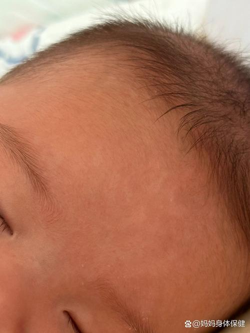 新生儿头上长小白泡是什么原因？需要治疗吗？-第2张图片-郑州医学网