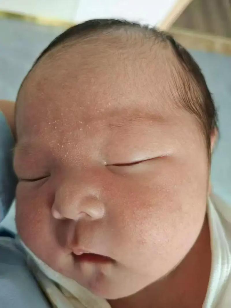 新生儿脸上粟粒疹图片长什么样？需要处理吗？-第2张图片-郑州医学网