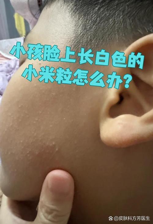 新生儿脸上粟粒疹图片长什么样？需要处理吗？-第1张图片-郑州医学网