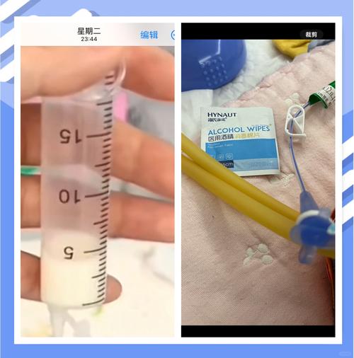 新生儿鼻饲喂养严重吗？背后隐藏的健康风险与护理要点有哪些？-第3张图片-郑州医学网