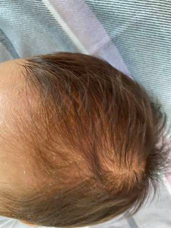 新生儿出现黄头发是营养不良还是正常生理现象？-第1张图片-郑州医学网