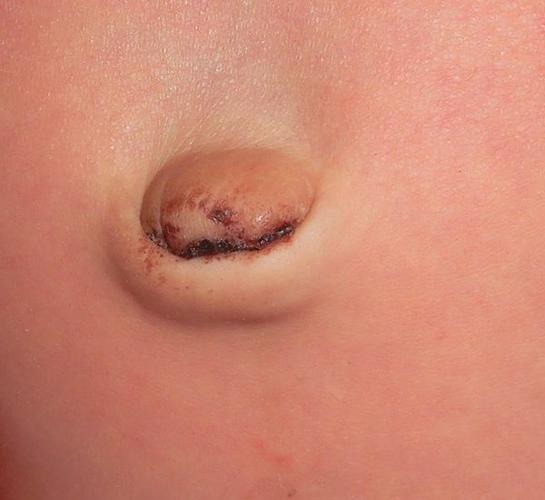 新生儿肚脐血痂脱落时流血正常吗？该怎么护理才能避免感染？-第1张图片-郑州医学网