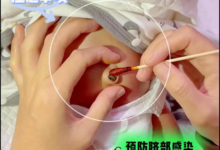 新生儿肚脐血痂脱落时流血正常吗？该怎么护理才能避免感染？-第2张图片-郑州医学网