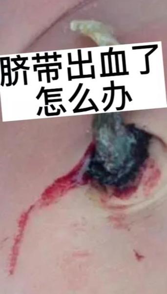 新生儿肚脐血痂脱落时流血正常吗？该怎么护理才能避免感染？-第3张图片-郑州医学网