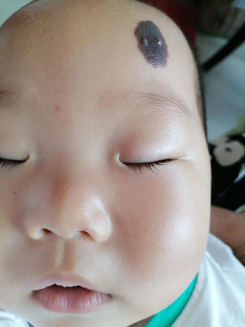 新生儿顺产后面部发紫是否属于正常生理现象?-第2张图片-郑州医学网 新生儿顺产后面部发紫是否属于正常生理现象?-第2张图片-郑州医学网