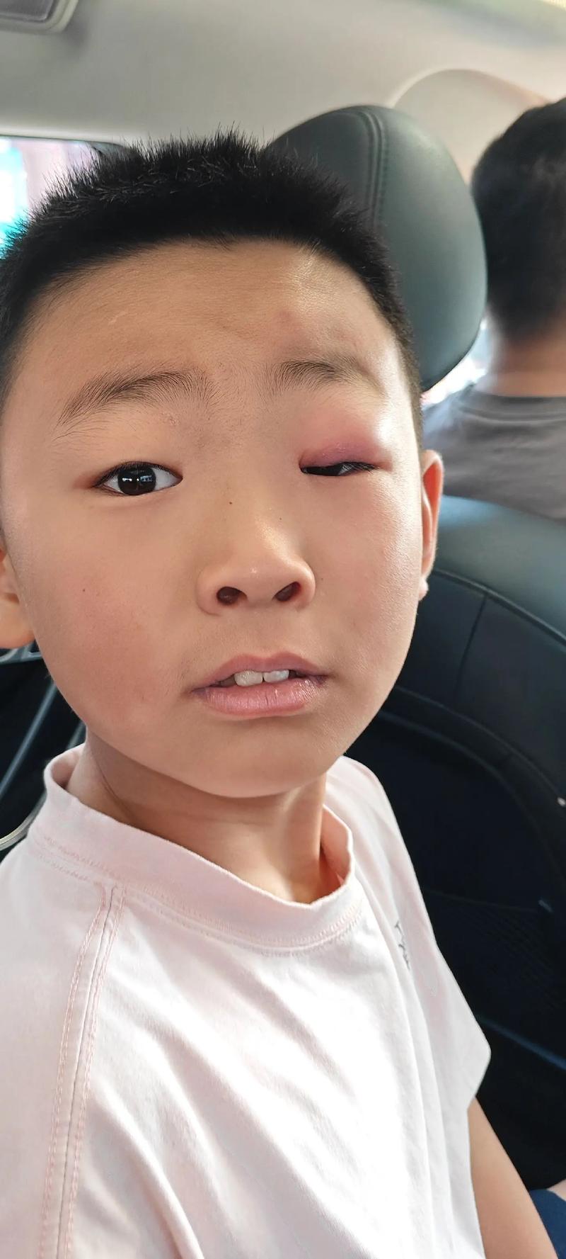 新生儿麦粒肿反复发作怎么办?家庭护理能自行消除吗?-第1张图片-郑州医学网 新生儿麦粒肿反复发作怎么办?家庭护理能自行消除吗?-第1张图片-郑州医学网