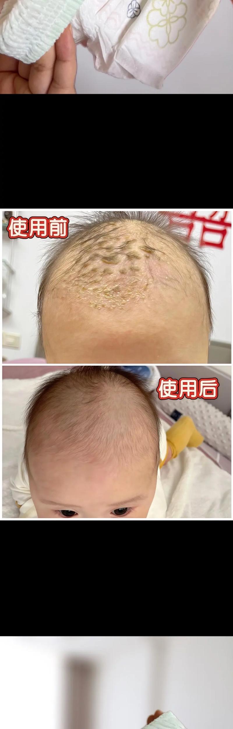 新生儿每天洗头好不好？频繁洗头会损伤头皮屏障吗？-第2张图片-郑州医学网