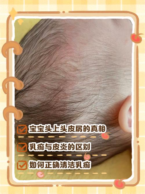 新生儿每天洗头好不好？频繁洗头会损伤头皮屏障吗？-第3张图片-郑州医学网