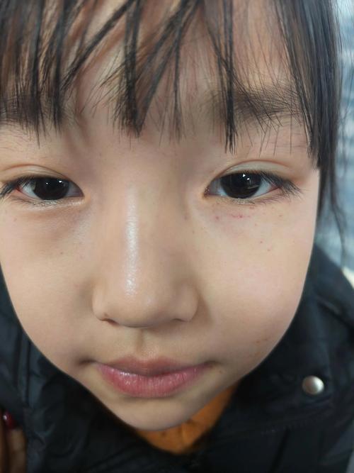 新生儿脸上出血点图片正常吗？需要担心还是会自行消退？-第1张图片-郑州医学网