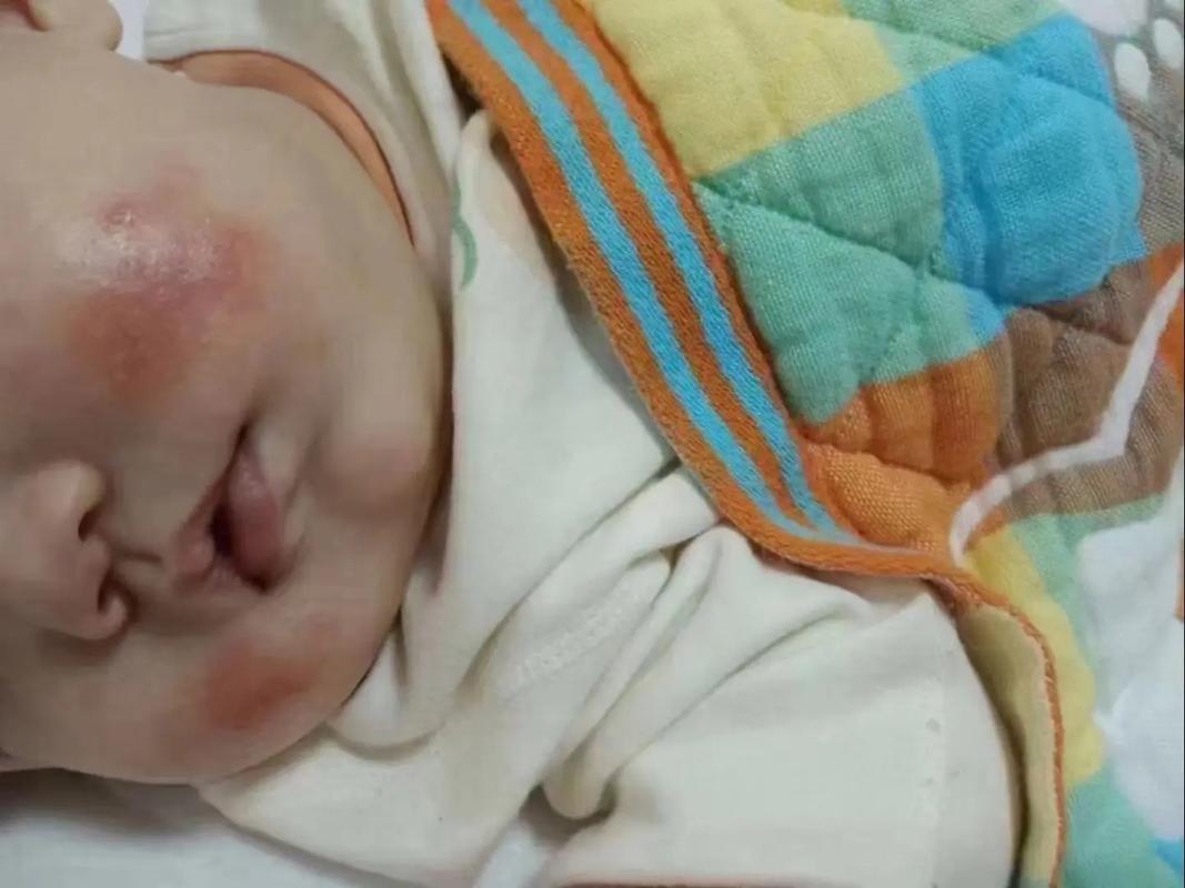 新生儿脸上出血点图片正常吗？需要担心还是会自行消退？-第2张图片-郑州医学网