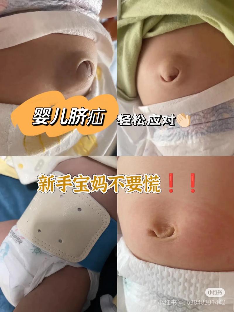 新生儿脐窦到底能不能自愈？需要家长注意哪些观察要点？-第2张图片-郑州医学网