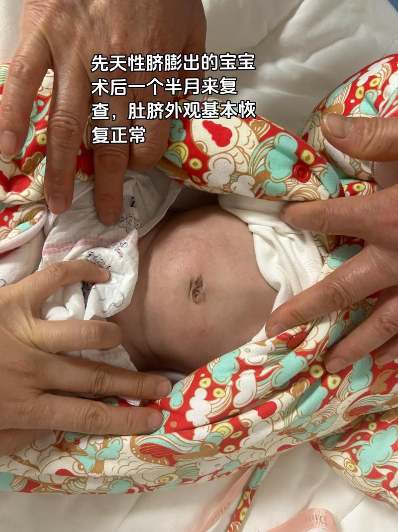 新生儿脐窦到底能不能自愈？需要家长注意哪些观察要点？-第1张图片-郑州医学网