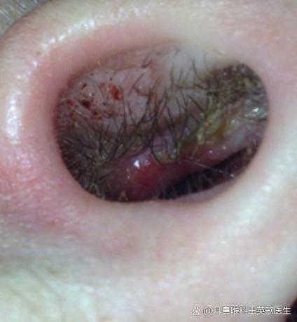 新生儿鼻孔红血丝图片正常吗？需要担心或处理吗？-第2张图片-郑州医学网