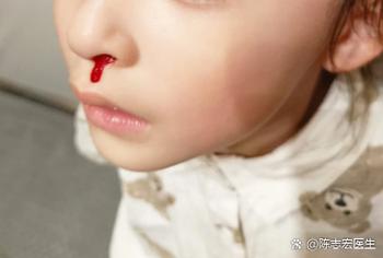 新生儿鼻孔红血丝图片正常吗？需要担心或处理吗？-第1张图片-郑州医学网